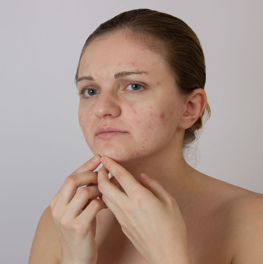 RevLite for Acne Scar Reduction