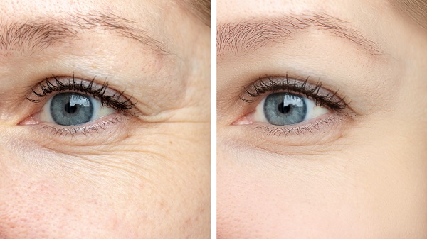  Best Non-Surgical Treatment for Wrinkles