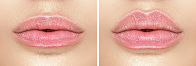 Lip injection or lip filler