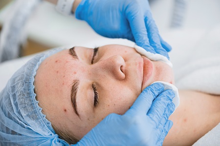 Role of Skin Tone in Acne Scar Treatment 