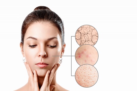 Types of Acne - Acne Scars